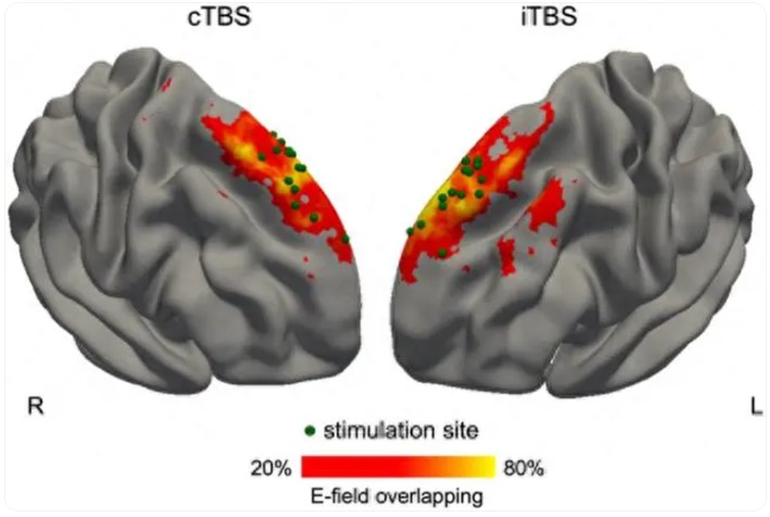 昌平实验室研发个体化神经调控疗法，对卒中后失语取得临床疗效(图1)